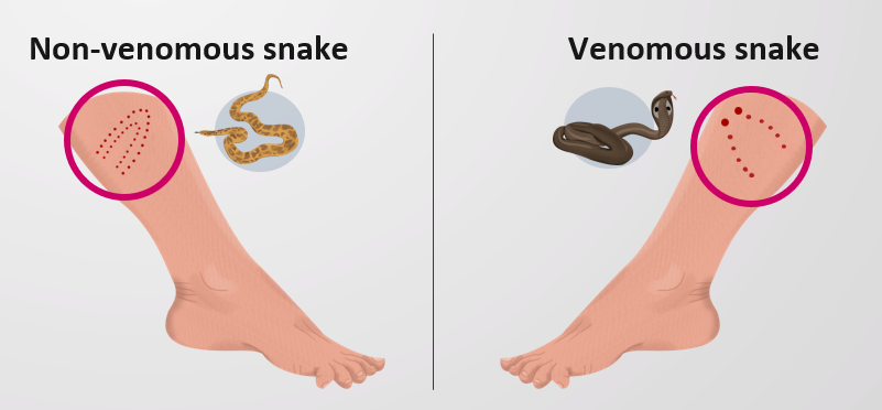 Types of snakebites [BYJU'S]