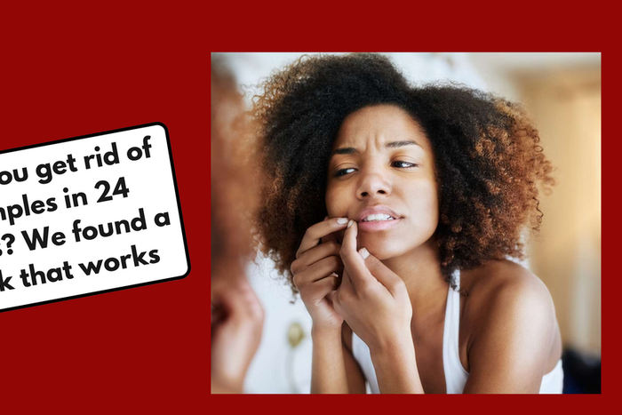 How to get rid of pimple