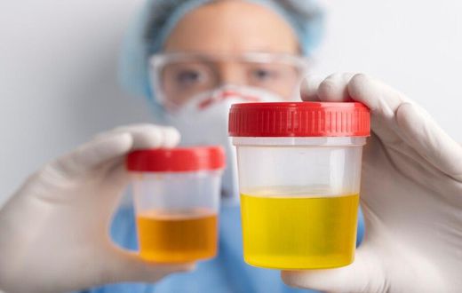 What's normal or not about your urine colour [MetropolisHealthcare]
