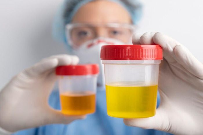 What's normal or not about your urine colour [MetropolisHealthcare]