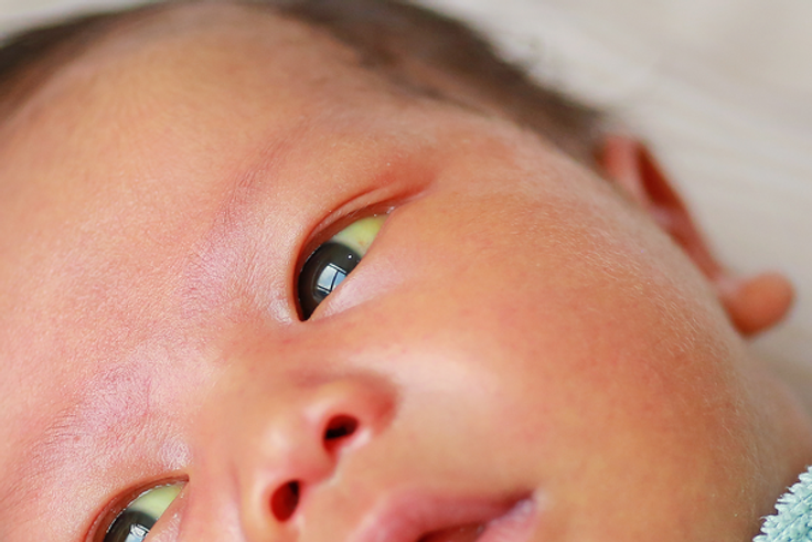 Babies with jaundice [NHS]