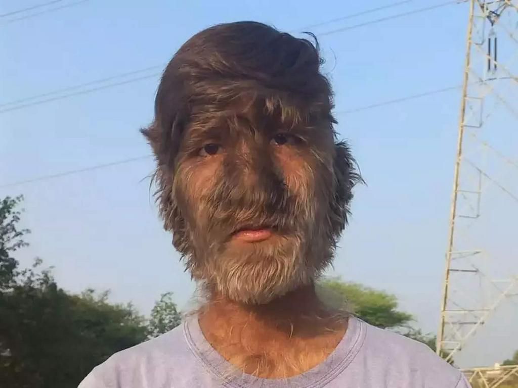 Man with werewolf syndrome [TheEconomicTimes]