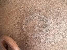 A child with a scalp ring worm