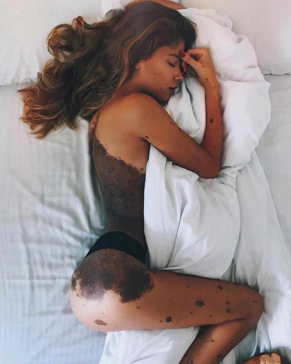 Woman covered in birthmarks [Facebook]