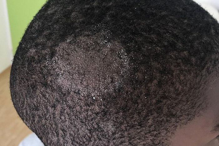 Scalp ringworm