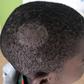 Scalp ringworm