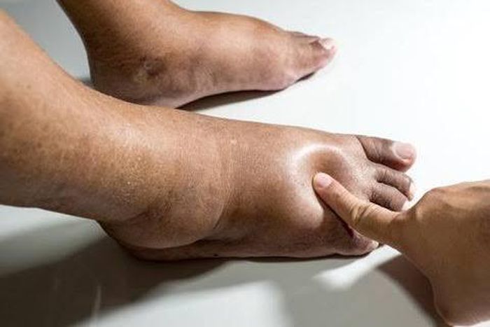 Swollen legs may be as a result of an underlying medical condition [Dr Segal]