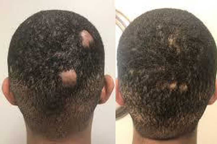 How to regrow bald spots [eternaldermatology]
