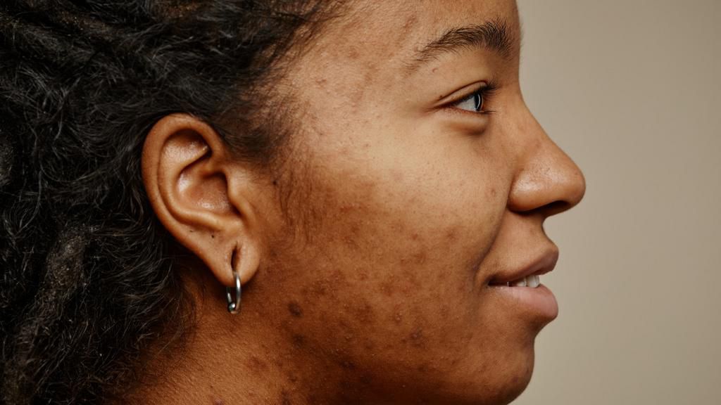 Honey will work overnight to reduce inflammation and redness [Vila Skin]