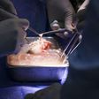 The pig kidney transplanted into Richard Slayman [MGH]