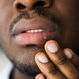 What to know about herpes [TribuneOnline]