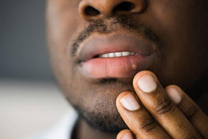 What to know about herpes [TribuneOnline]
