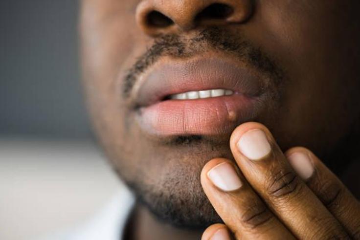 What to know about herpes [TribuneOnline]