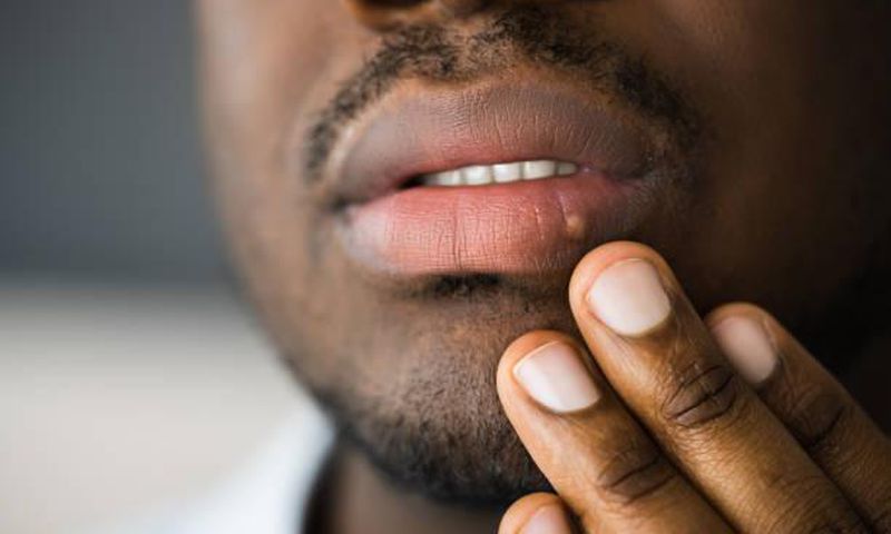 What to know about herpes [TribuneOnline]