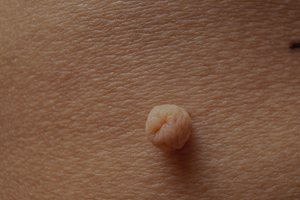 What are skin tags? [LondonDermatology]