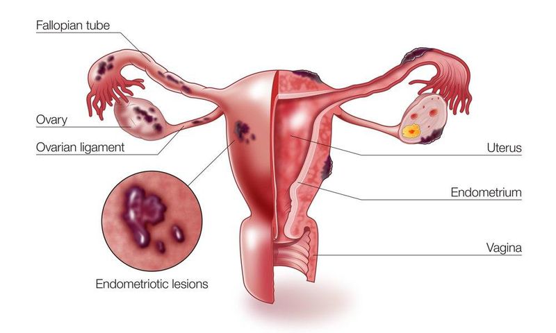 A diagram showing how endometriosis occurs in female reproductive organs