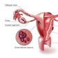 A diagram showing how endometriosis occurs in female reproductive organs