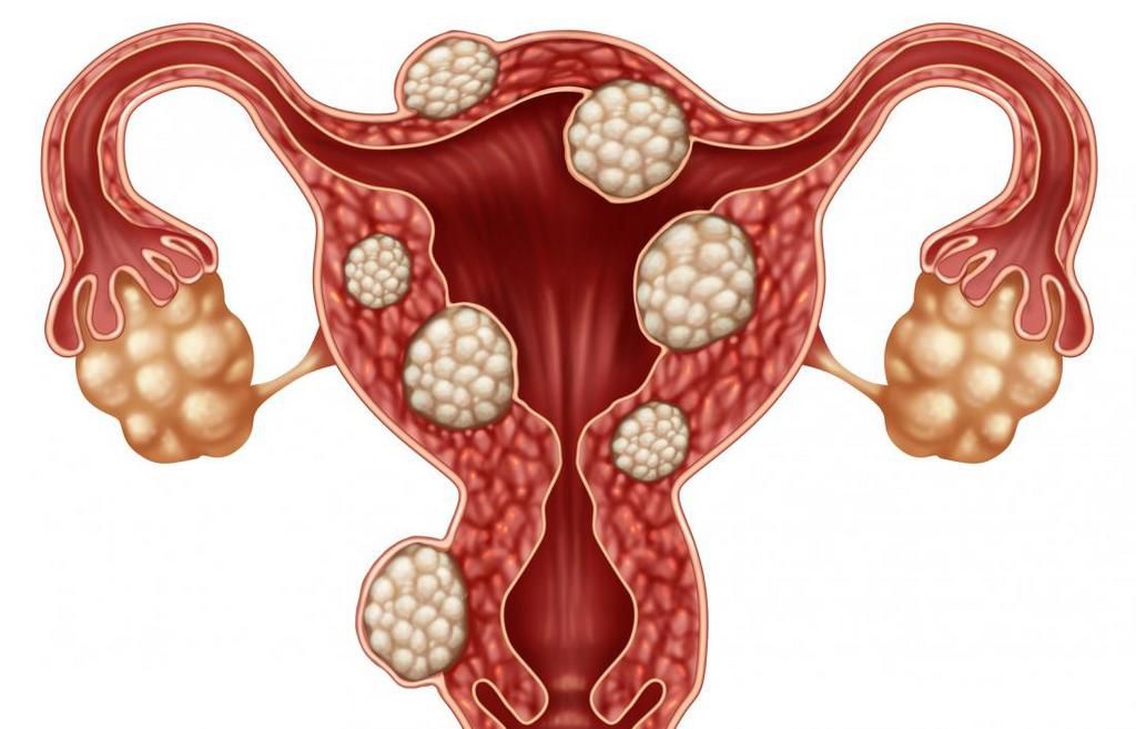 Everything you need to know about fibroids. [medicalnewstoday]