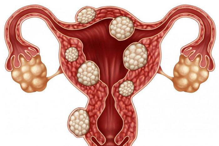 Everything you need to know about fibroids. [medicalnewstoday]