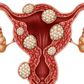 Everything you need to know about fibroids. [medicalnewstoday]