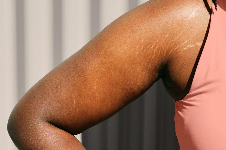 How to get rid of stretch marks [inkillusions]