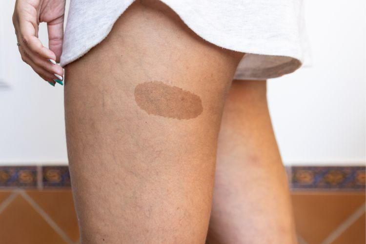 Birthmarks on thighs [SunDoctors]