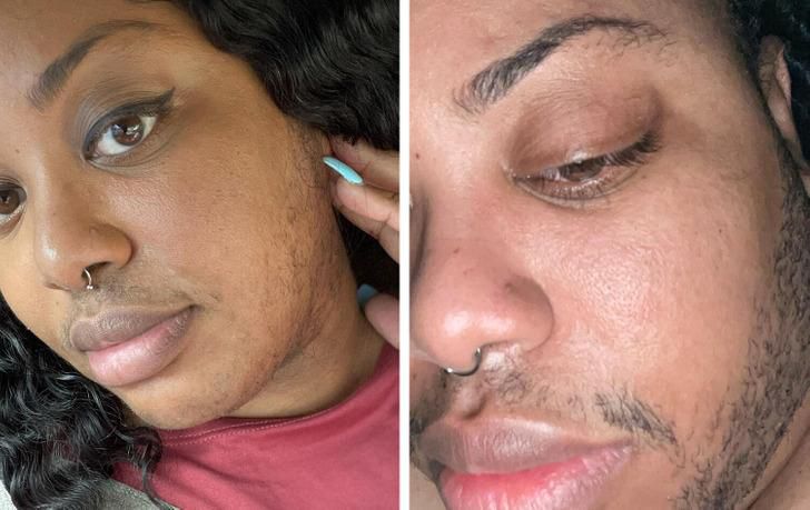 Hirsutism [BrightSide]