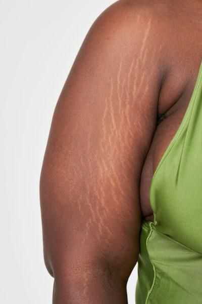 How to get rid of stretch marks [Skinhouseluton]