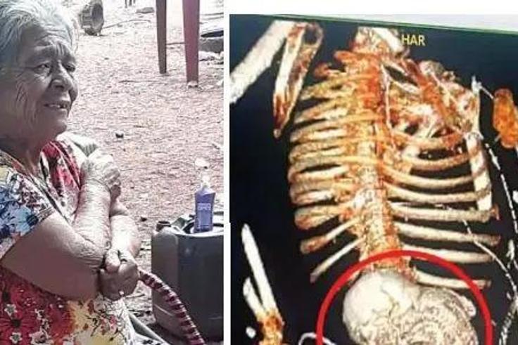 Woman carries dead foetus for 56 years, dies after removal surgery