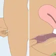 How to use the cervical cap [Wikihow]