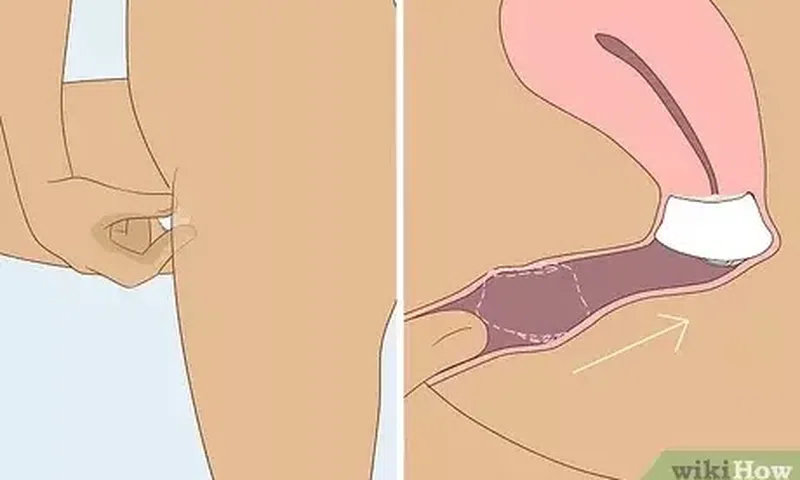 How to use the cervical cap [Wikihow]