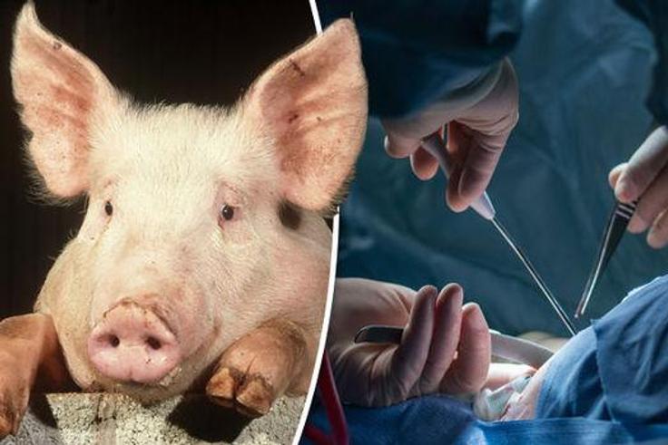 Kidney transplant done with pig's kidney [dailyexpress]
