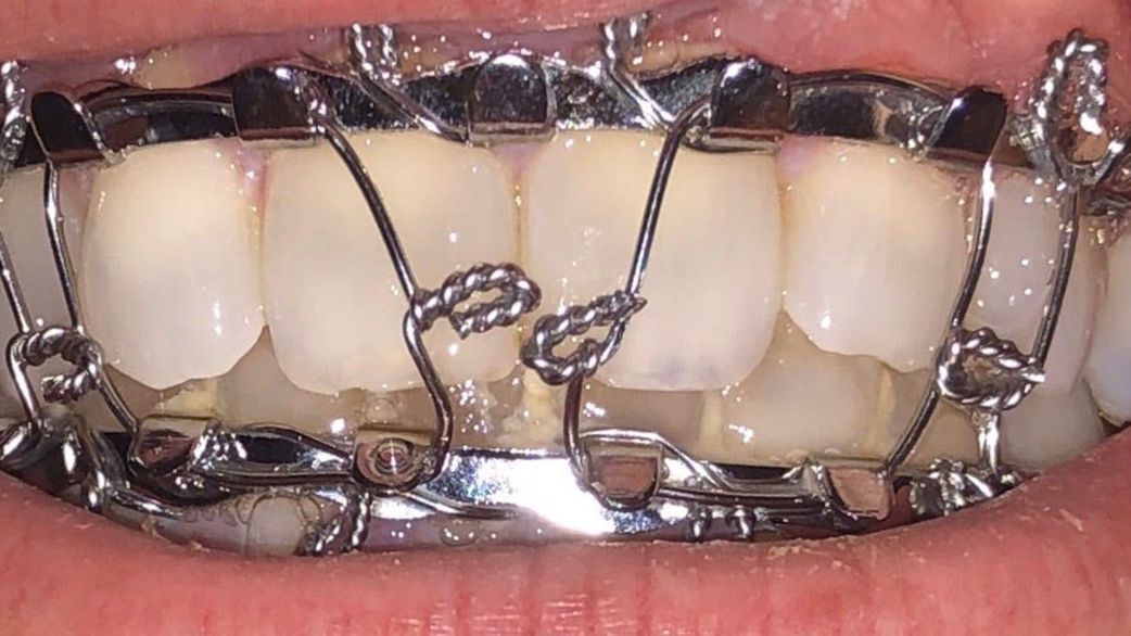 Lose 15kg In 6 Weeks: The shocking reality of jaw wiring