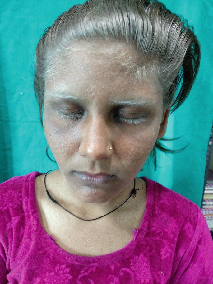 Person with Griscelli syndrome [springerlink]