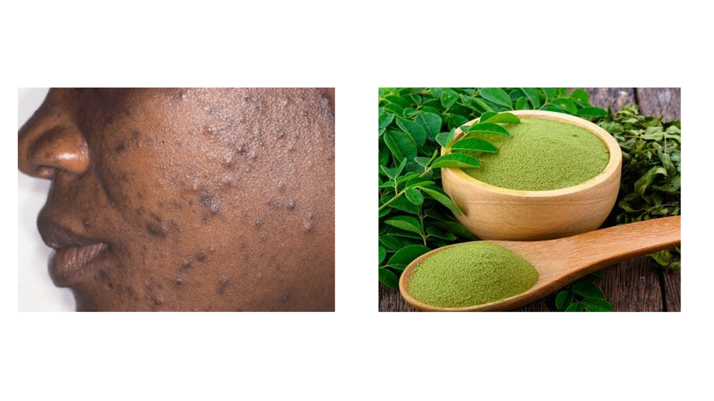 Moringa powder for acne hotsell