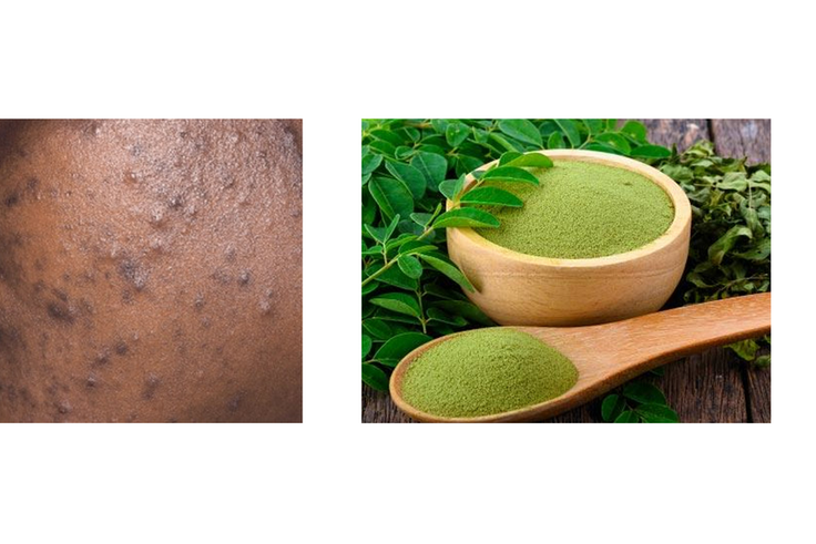 How moringa leaves can clear acne and pimples [datelinehealth/moringaleaves]
