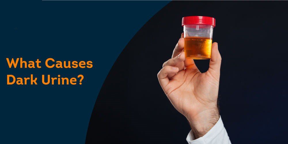 Urine color can vary depending on a variety of factors, says an expert. Morning urine is often darker due to dehydration, concentration of waste products, and melatonin production at night. Foods, medications, and water consumption also affect its color. Although normal, persistent dark urine can indicate a health problem. When in doubt, consult a doctor.