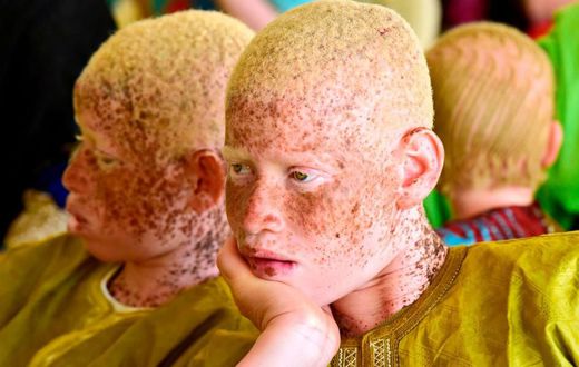 5 harmful myths about albinos you must STOP believing