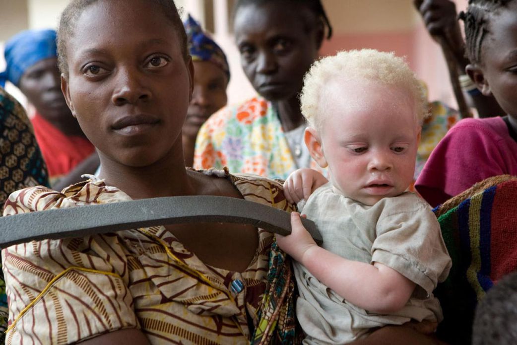 5 harmful myths about albinos you must STOP believing