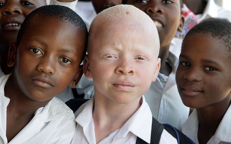 5 harmful myths about albinos you must STOP believing