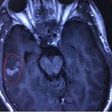 A scan showing a 10cm-long tapeworm swimming in the brain of 26-year-old Chinese man, Liu.