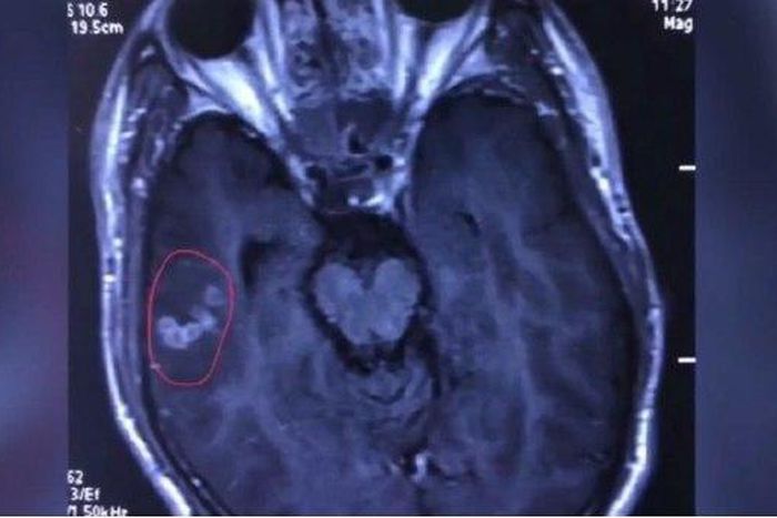 A scan showing a 10cm-long tapeworm swimming in the brain of 26-year-old Chinese man, Liu.