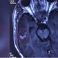 A scan showing a 10cm-long tapeworm swimming in the brain of 26-year-old Chinese man, Liu.