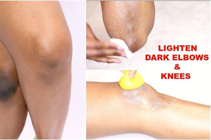 Here are 5 ways to naturally get rid of dark elbows and knees