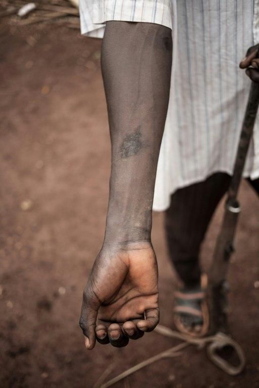 Brice, a man who was tortured by the the LRA while hunting in the bush, shows burn scars on his arm
