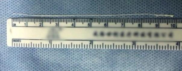 ___8857932___2018___9___15___10___tapeworm+nst