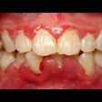 3 home remedies to get rid of gingivitis. [pinterest]