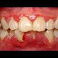 3 home remedies to get rid of gingivitis. [pinterest]