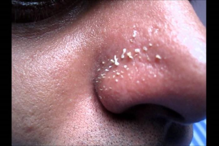 4 natural ways to get rid of whiteheads on the nose