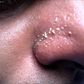 4 natural ways to get rid of whiteheads on the nose